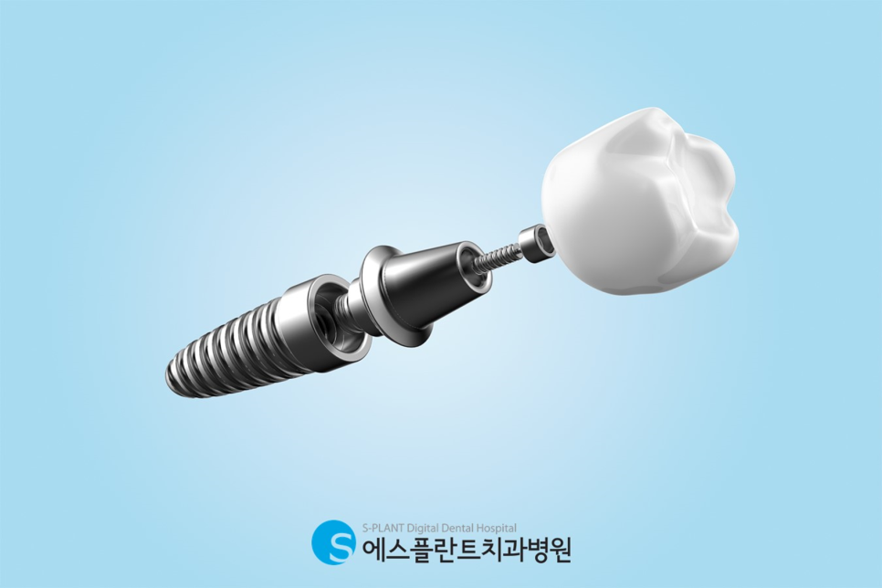 Apgujeong Senior Implants Completed with the Latest Technology at Esplant Dental Clinic image 2