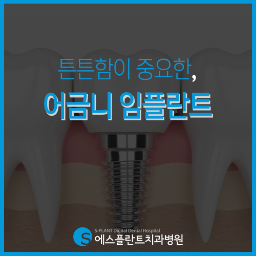 저작기능의 핵심, 튼튼함이 중요한 어금니 임플란트 [에스플란트 치과병원] 관련 이미지 2