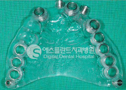 당뇨·고혈압 환자, 가상수술로 임플란트 걱정 끝 관련 이미지 3