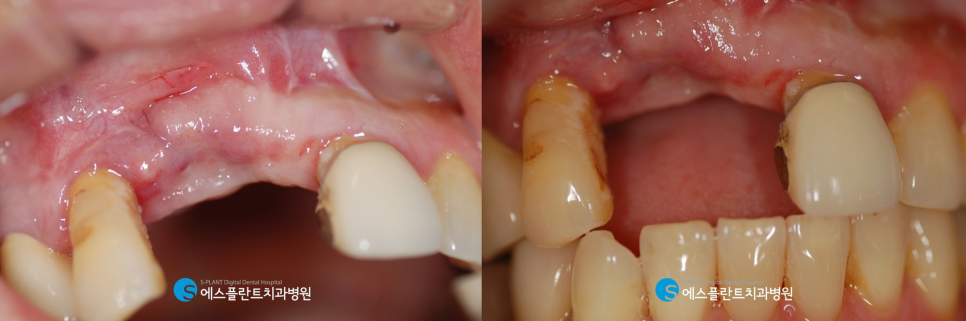 에스플란트치과병원의 잇몸이식술(Connective Tissue Graft, CTG) 로 단단한 잇몸 만들기 관련 이미지 2