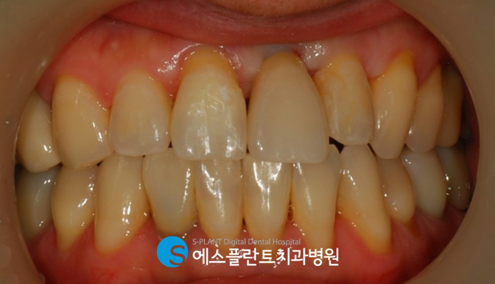 압구정로데오역 발치 후 즉시 임플란트 식립 잘하는 치과, 에스플란트 치과병원 관련 이미지 3