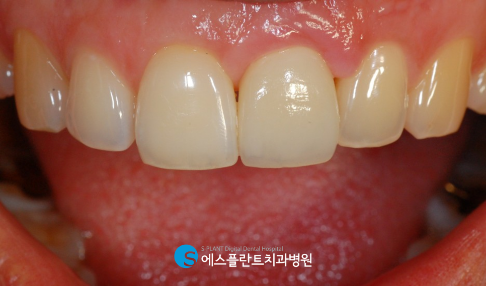심미성과 기능성을 모두 고려한 압구정로데오 에스플란트치과병원의 앞니 임플란트 (가이드 임플란트) 관련 이미지 7