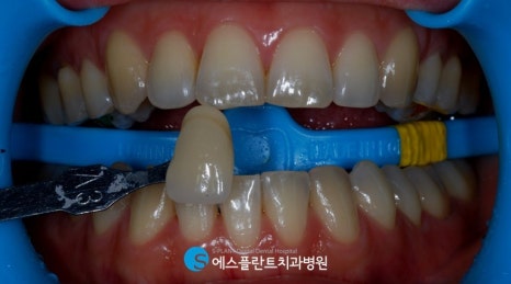 강남 전문가 치아미백, 에스플란트 치과병원에서 변색된 치아를 하얗게 관련 이미지 5