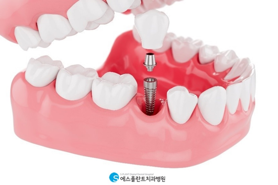 당뇨, 고혈압 환자 임플란트 왜 어려울까요? 관련 이미지 2