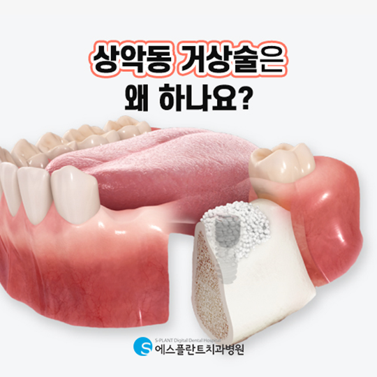 어금니임플란트 전 상악동거상술이 필요한 경우는? 관련 이미지 2