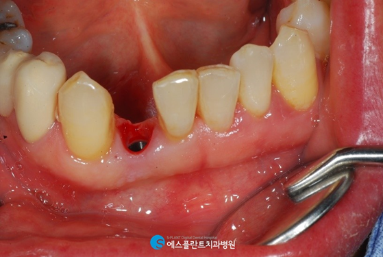 하악 전치부 치아손상, 임플란트로 심미성을 회복하세요! 관련 이미지 4