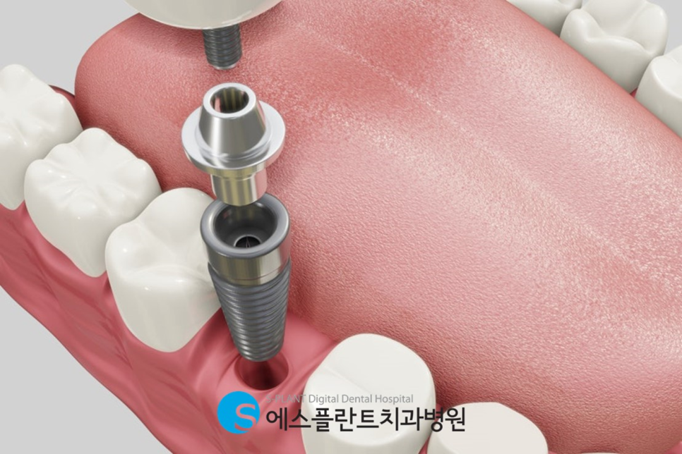청담 에스플란트치과 즉시기능 임플란트, 빠르고 튼튼한 선택! 관련 이미지 2