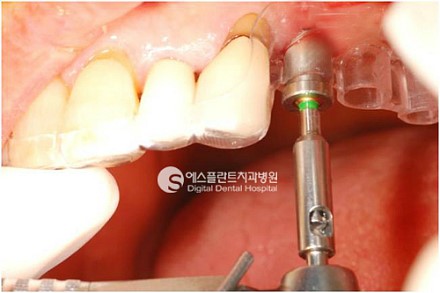 임플란트 통증을 최소화한 아나토마지가이드 임플란트 시술법! 관련 이미지 4