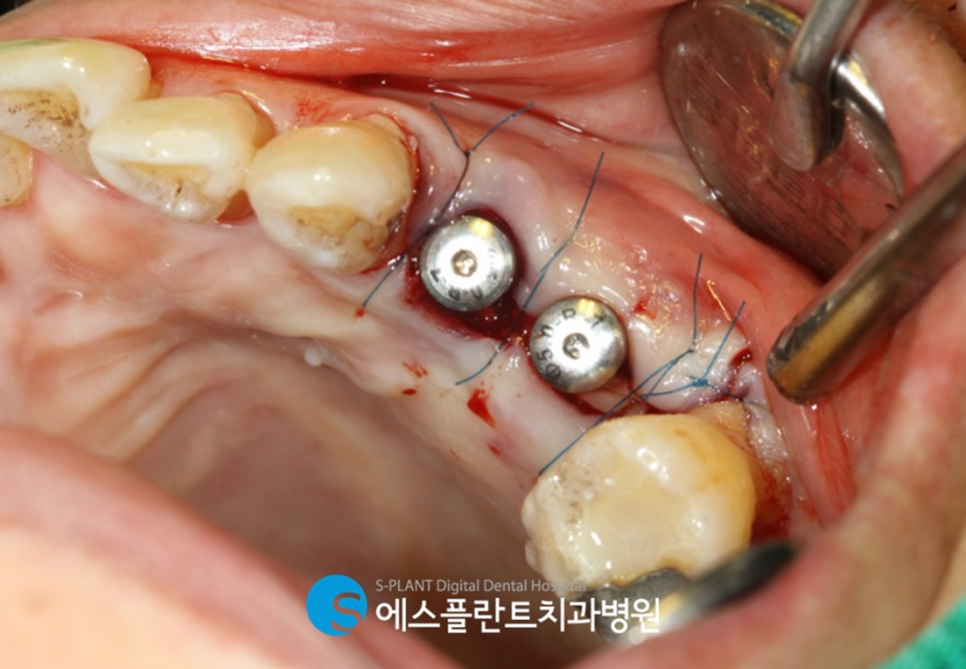 강남치과 에스플란트치과병원의 자가혈 임플란트(PRF)로 높은 성공률과 빠른 회복 관련 이미지 7