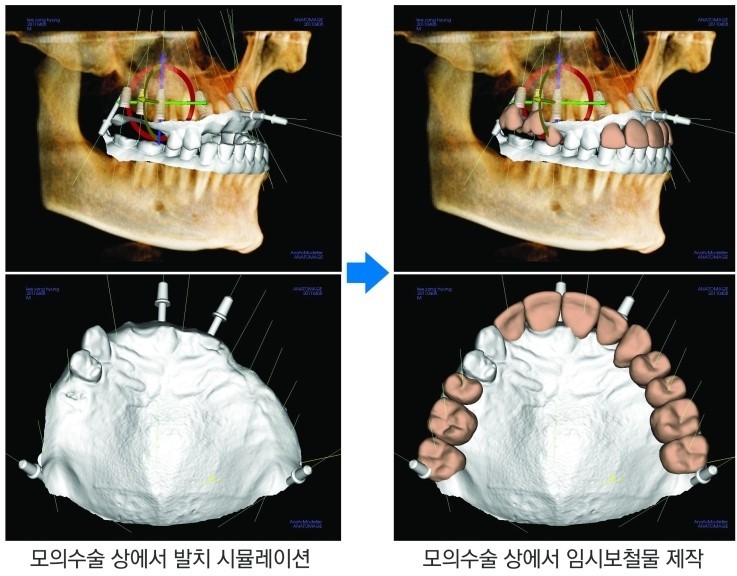 [앞니임플란트] 앞니 임플란트가격, 어금니 임플란트 가격 관련 이미지 6