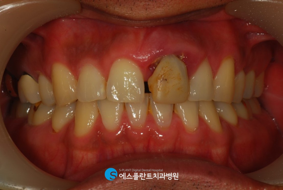 압구정로데오역 임플란트 잘하는 에스플란트치과병원, 당일 임플란트 발치 후 즉시 식립 임플란트 관련 이미지 2