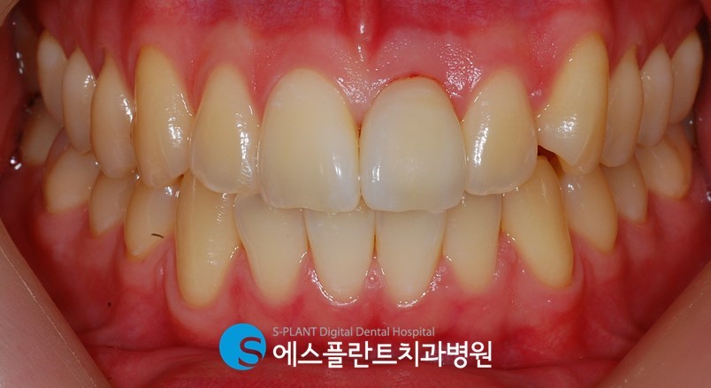 강남 발치 후 즉시임플란트 가능한 치과, 에스플란트 치과병원 관련 이미지 3