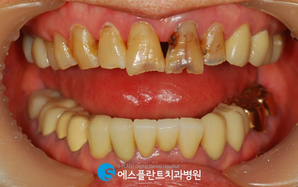 치아노화로 인한 기능 및 심미적인 부분의 개선을 원한다면?! 강남 앞니 심미보철 잘하는 치과 에스플란트치과병원에서 관련 이미지 3