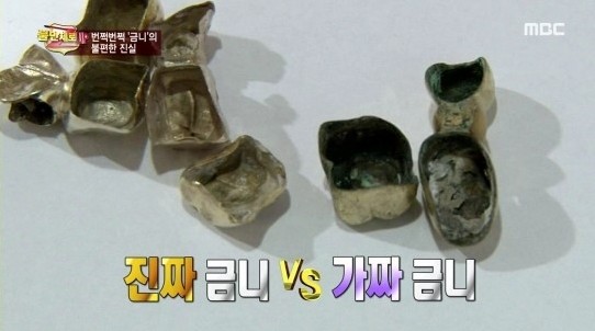 금니, 꼼꼼히 따져봐야 후회 없다 관련 이미지 2
