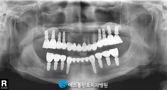어금니임플란트로 건강한 식생활을 유지하세요! 관련 이미지 6