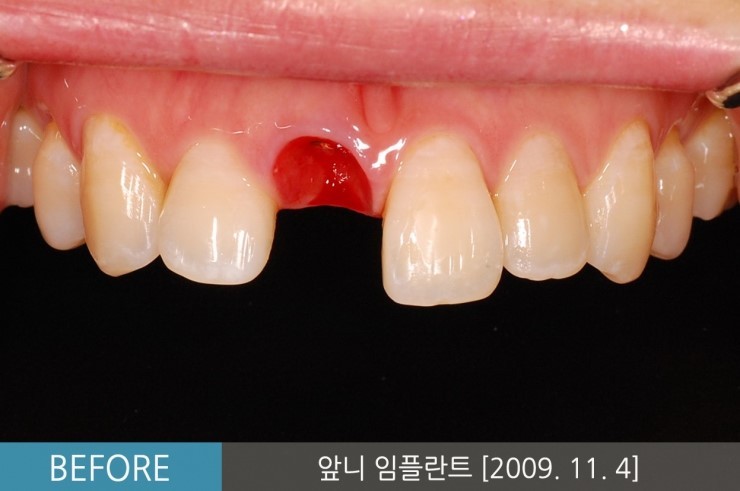 [앞니임플란트기간] 앞니임플란트, 당일 발치 후 즉시 식립 임플란트 CASE 관련 이미지 3