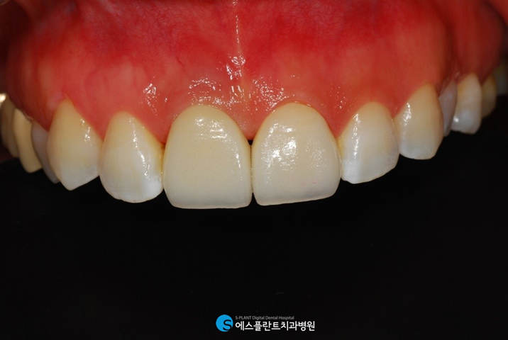 치아가 1/2 이상 부러졌다면? 크라운 치료 진행하세요. 관련 이미지 5