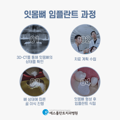 뼈이식 임플란트, 튼튼한 뼈는 임플란트 성공의 핵심 [에스플란트 치과병원] 관련 이미지 4