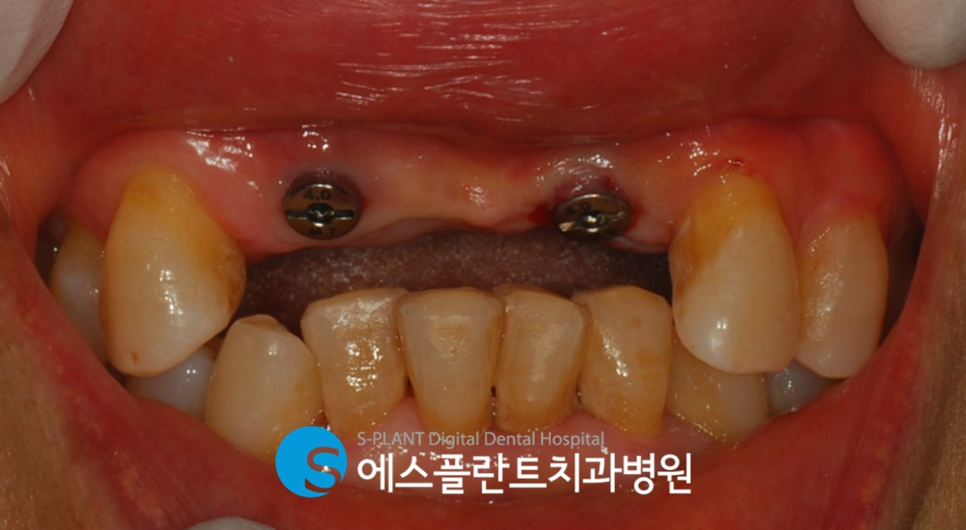 심한 골흡수가 있는 전치부 임플란트 잘하는 강남치과, 에스플란트치과병원 관련 이미지 5