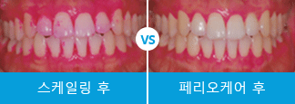 만성치주염 환자를 위한 에스플란트 치과병원의 맞춤관리 관련 이미지 7