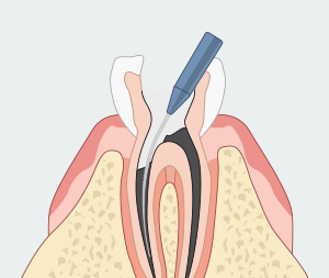 자연치아를 최대한 보존하기 위한 신경치료 [에스플란트 치과병원] 관련 이미지 4