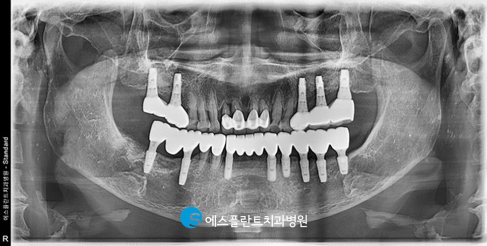 흔들리는 앞니 가이드 임플란트 브릿지 잘하는 치과 에스플란트치과병원 관련 이미지 6