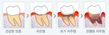 [치주질환]만성치주염, 잇몸건강 알아보기 관련 이미지 2