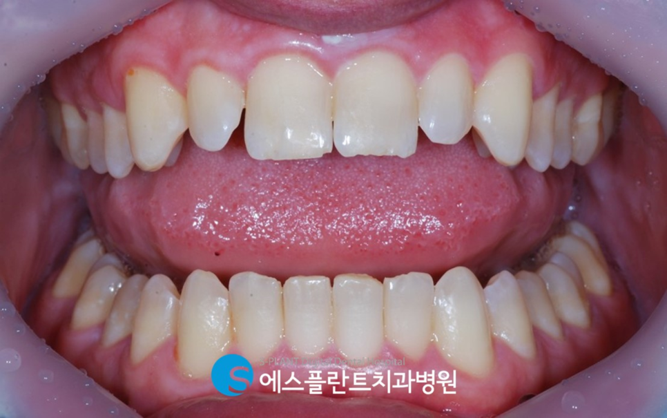 청담 에스플란트치과병원의 전치부 앞니 지르코니아 크라운 심미보철로 치아를 예쁘고 가지런하게 관련 이미지 2