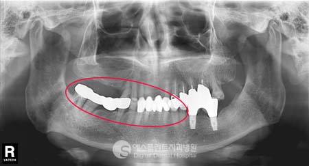 상악동 거상술 진행 후 임플란트 식립 실제사례 [에스플란트 치과병원] 관련 이미지 2