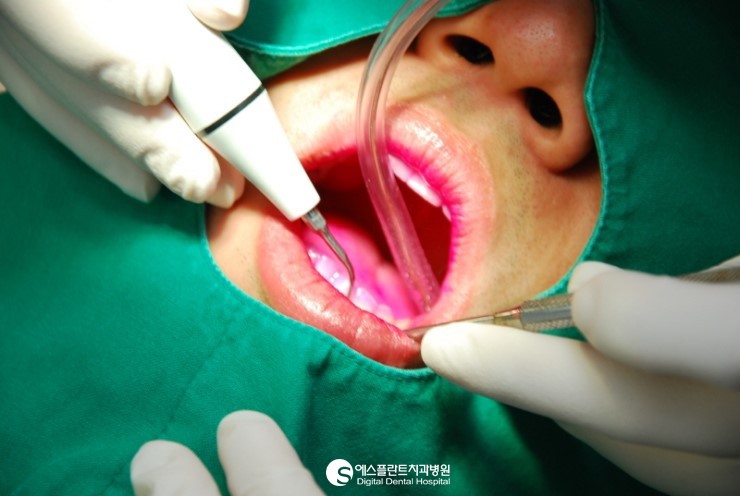 [흡연과 치아건강] 담배는 멀리, 칫솔은 가까이! 흡연자 구강관리 프로 그램 관련 이미지 2