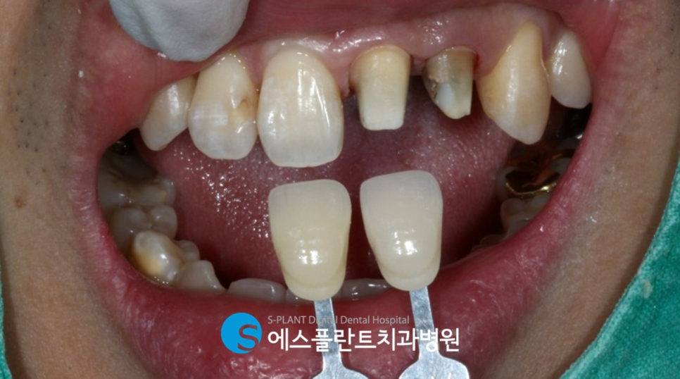 강남 오래된 앞니 보철물 치료는 에스플란트치과병원에서 관련 이미지 4