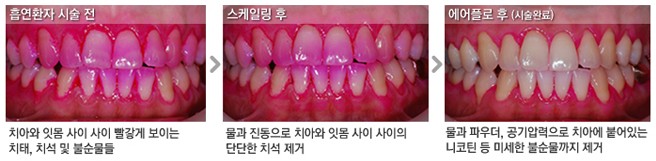 [흡연과 치아건강] 담배는 멀리, 칫솔은 가까이! 흡연자 구강관리 프로 그램 관련 이미지 4