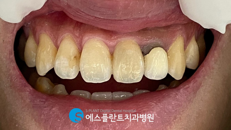 강남 오래된 앞니 보철물 치료는 에스플란트치과병원에서 관련 이미지 2