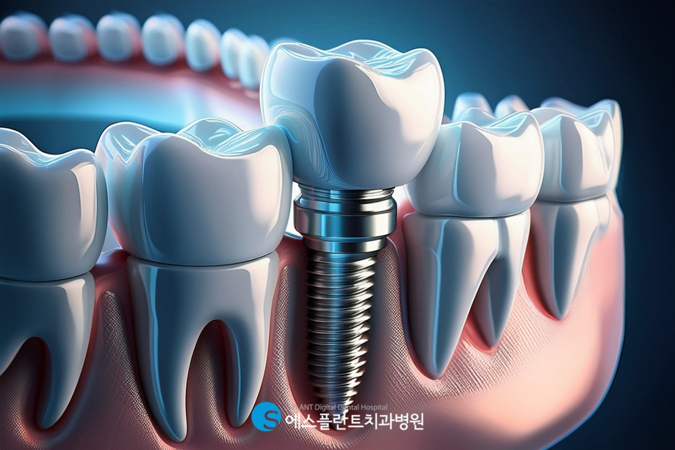청담 에스플란트치과에서 임플란트 치료과정, 빠르고 안전한 이유! 관련 이미지 2