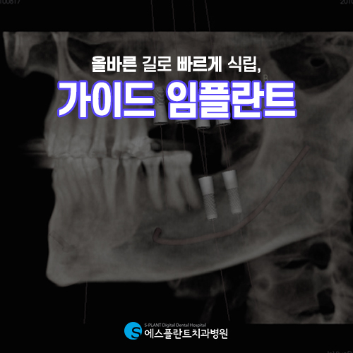 실수가 있어서는 안되니까 에스플란트의 가이드 임플란트 관련 이미지 2