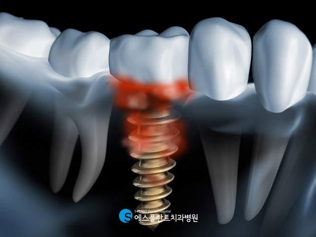 임플란트주위염 미리 예방하는 방법 없을까요? – 에스플란트치과병원 관련 이미지 2