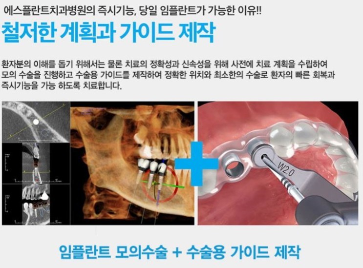 당일 임플란트, 정확하고 회복도 빠른 이유 관련 이미지 4