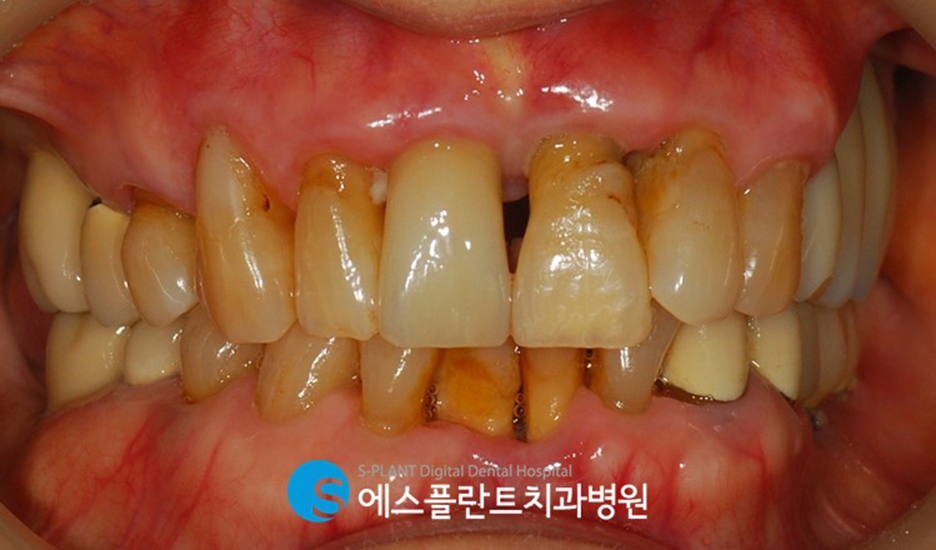 앞구정앞니임플란트 심한 치주염으로 인한 골이식을 동반한 전치부 앞니 임플란트 관련 이미지 2