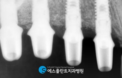 저작기능의 핵심, 어금니 임플란트 식립에는 압구정 에스플란트 치과병원의 가이드 임플란트 관련 이미지 8