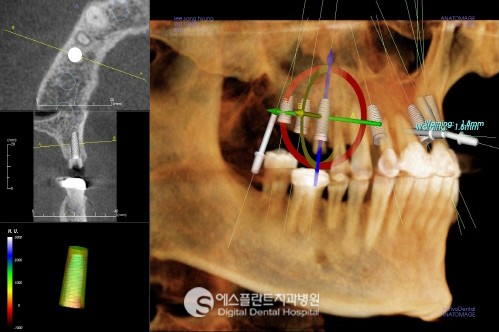 [당뇨임플란트] CT 임플란트 중요성, 임플란트 당뇨랑 상관있나요? 관련 이미지 2