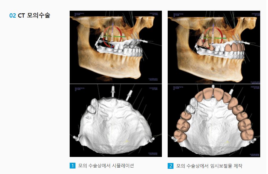 임플란트, 나에게 딱 맞는 가이드를 통해 보다 안전하게 [에스플란트 치과병원] 관련 이미지 6