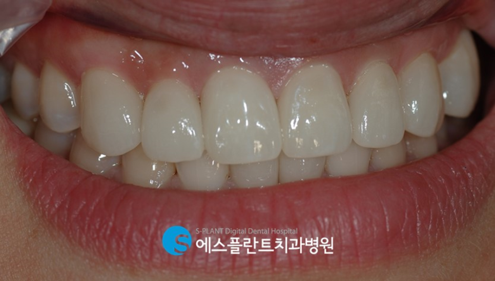 앞니 깨짐으로 인한 심미보철을 원한다면 - 강남 심미보철 잘하는 치과 에스플란트치과병원에서 관련 이미지 5