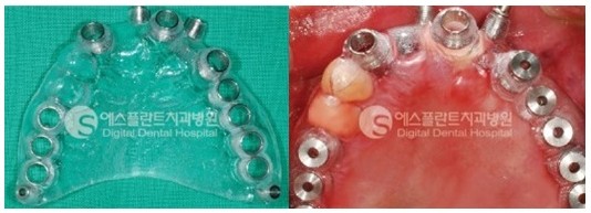 [즉시식립임플란트] 에스플란트치과병원 이정택 원장이 추천하는 즉시 식립 임플란트! 관련 이미지 4