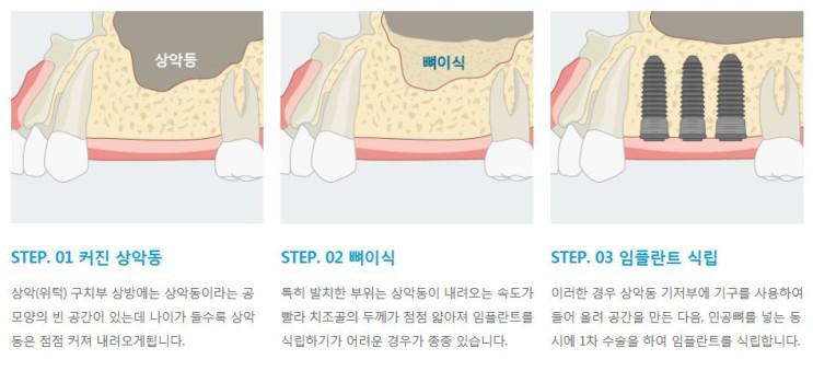 임플란트가 치매예방에 도움이 된다고? 에스플란트치과병원 관련 이미지 7