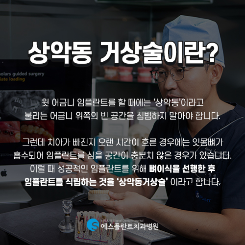고난이도 상악동 거상술 임플란트 잘하는 치과, 에스플란트 치과병원 관련 이미지 2