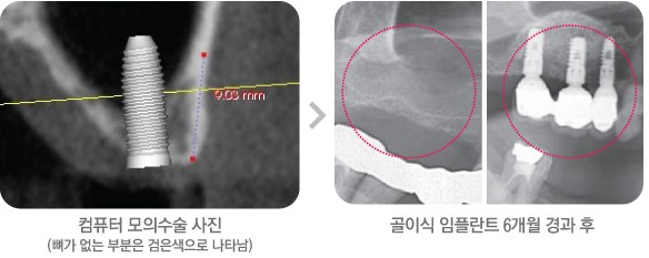 [뼈이식임플란트통증] 강남임플란트, 잇몸 뼈 이식을 꼭 해야하나요? 관련 이미지 1