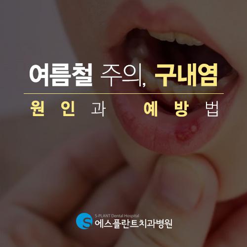 여름철입안염증,하얗게움푹구내염주의 관련 이미지 1