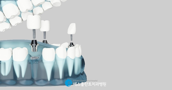 노인임플란트, 건강보험을 적용해 에스플란트치과에서 진행하세요! 관련 이미지 4