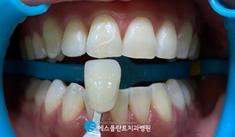 강남 전문가 치아미백, 에스플란트 치과병원에서 변색된 치아를 하얗게 관련 이미지 6