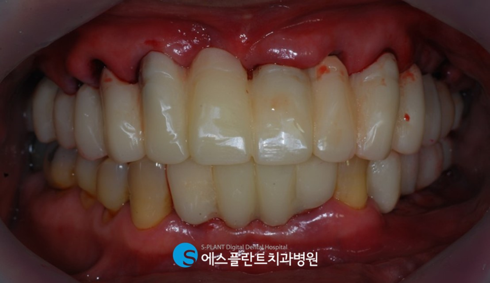 압구정 임플란트, 에스플란트치과병원의 편안하고 정확한 식립이 가능한 전악 가이드 임플란트 관련 이미지 10